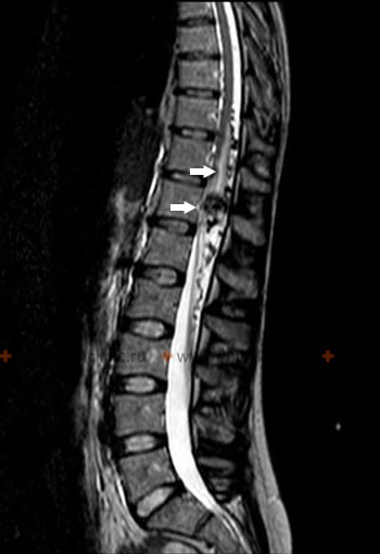 МРТ спинного мозга показывает артериовенозную мальформацию (АВМ) на уровне конуса спинного мозга (указана стрелками).